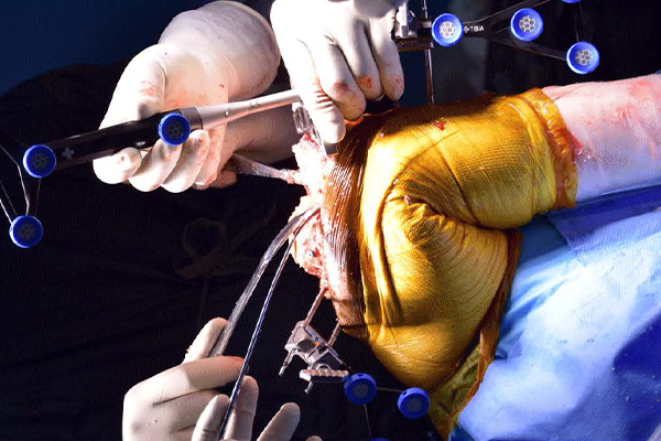 First Robotic Knee & Hip Replacement Surgery in Madurai