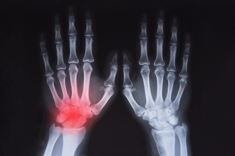 Rheumatology Treatment