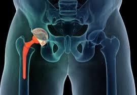 Hip replacement surgery