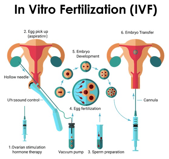 IVF Treatment