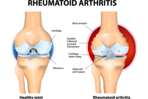Advanced Rheumatology Services