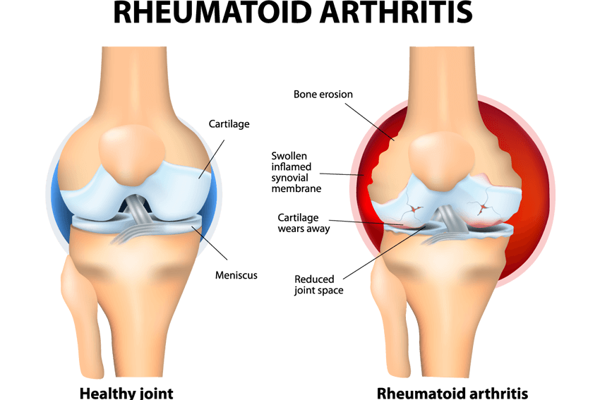 Advanced Rheumatology Services