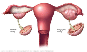 PCOS Treatment for Women in Madurai