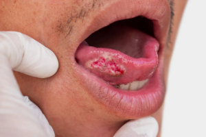 Oral Cavity Cancer Surgery in Madurai