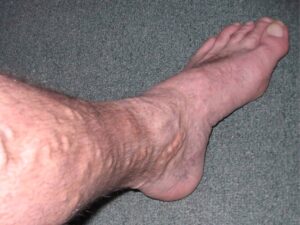 Varicose Veins Treatment in Tamil Nadu