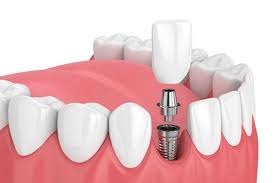 Dental Implant Surgery in Madurai